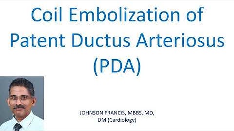Coil Embolization of Patent Ductus Arteriosus PDA
