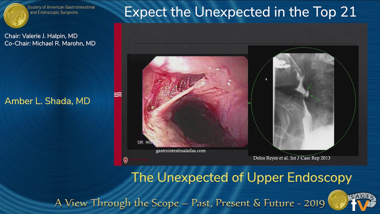 The Unexpected Of Upper Endoscopy YouTube The Unexpected Of Upper Endoscopy YouTube