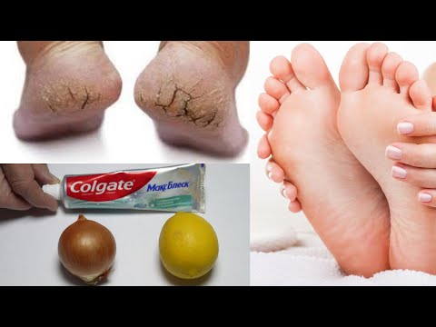 THE MOST EFFECTIVE TREATMENT FOR CRACKED HEELS