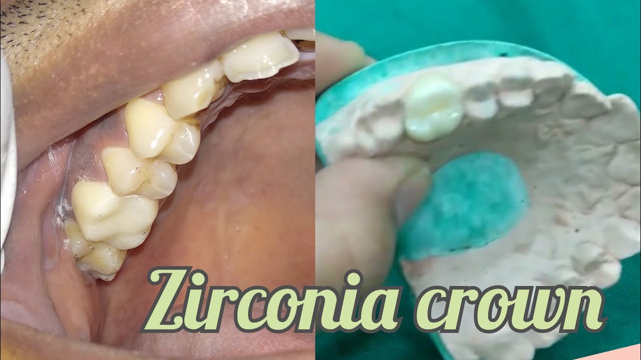 Zirconia crown placed at our clinic | You can't identify which one is real tooth