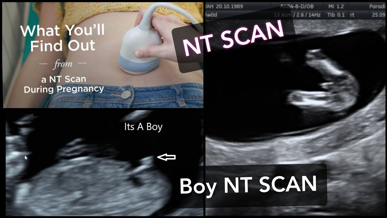 NT SCAN How To Find Baby s Gender In NT SCAN NT Scan Report NT SCAN How To Find Baby s Gender In NT SCAN NT Scan Report