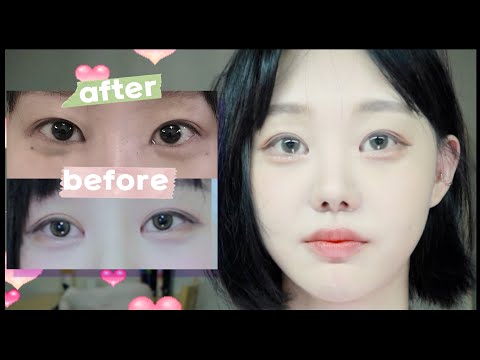 앞트임 복원 기록 ~10일 | 😱주의