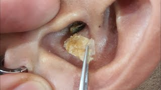 耳掃除の難聴 最大の耳垢除去 | T7H35