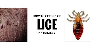 CHEAP \& EASY WAY TO GET RID OF HEAD LICE THAT DOCTORS WONT TELL YOU!! Guaranteed to Work!  ✓