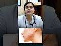 PNEI Axis होता क्या है और इससे ACNE का सम्बन्ध क्या है ?? #acnetreatment #acne #pimples #homeopathy