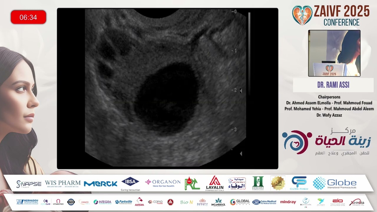 محاضرة دكتور رامي عاصي Duo stimulation in poor responders من مؤتمر ZAIVF