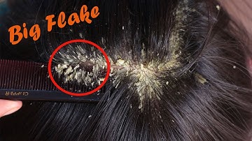Dandruff Flakes Scratching So Nice!! Dandruff Removal Satisfying #638