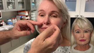 My Deep Plane Facelift Journey | Part 2 of 4 | by Dr. Philip Solomon in Toronto, ON