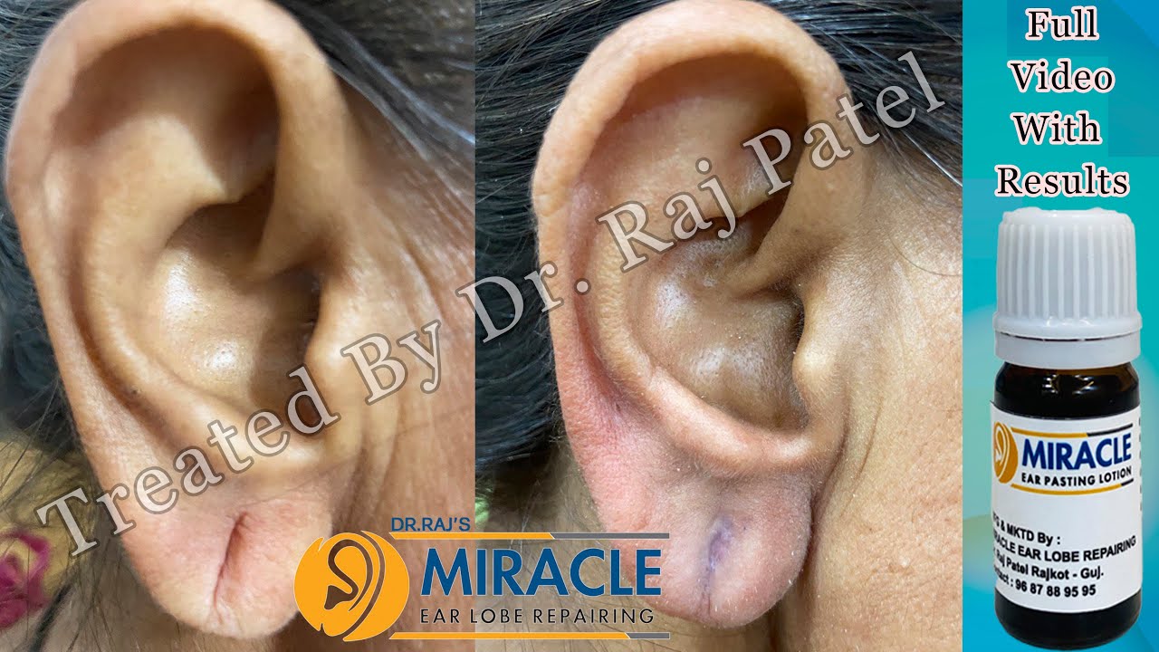 Ear Pasting Lotion Available Torn Ear lobe /Ear Lobing Torn Ear / Hole