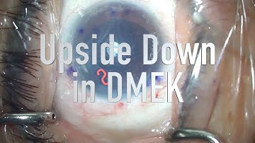 Upside-down DMEK graft