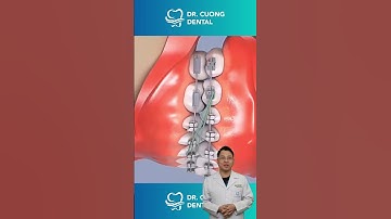 Quá trình di chuyển các răng trong niềng răng |Dr Cường Official