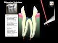 Integrated Endodontics Mi-EndoUltra Multi-Purpose Ultrasonic Endo Tips (Pack of 1) - 4