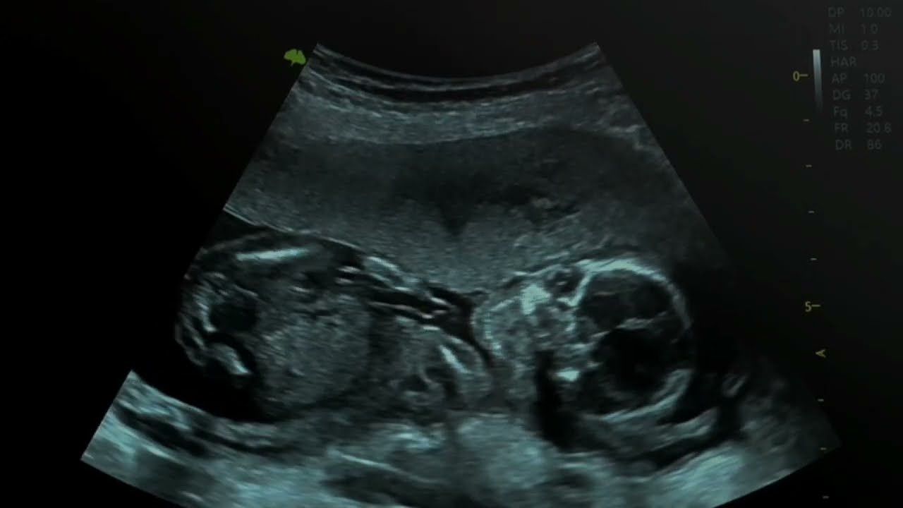 Feto Humano 16 Semanas Semana 10 (para Padres) | Nemours KidsHealth