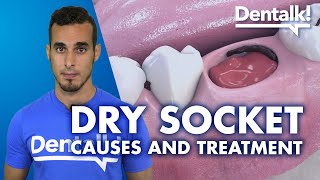 DRY SOCKET – Symptoms, treatment and causes of INFECTED tooth extraction | Dentalk! ©