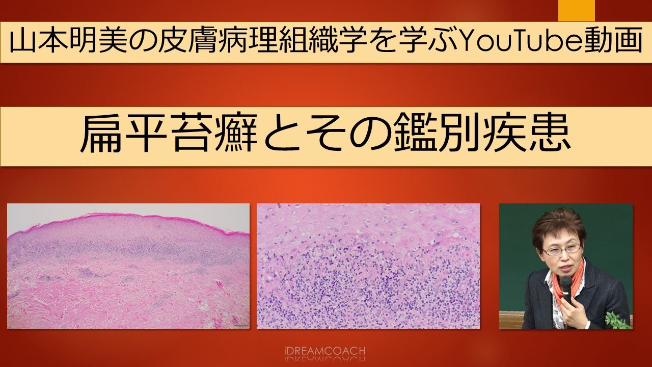 扁平苔癬と鑑別疾患の解説 #dermatopathology #山本明美 #扁平苔癬 #Lichenplanus - YouTube