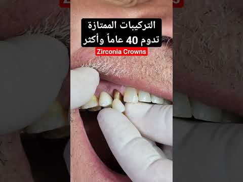 تركيب أسنان زيركون جديدة واستبدال تلبيسات قديمة