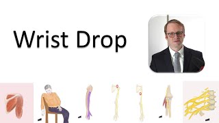 Wrist Drop and the Radial Nerve