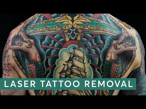 Removing Colour Tattoos - The TRUTH about Laser Tattoo Removal