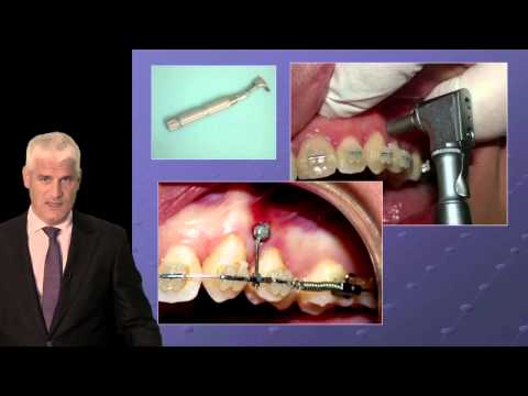 202-00 Implant-Assisted Orthodontics: Moving Toward a Better Tomorrow PREVIEW