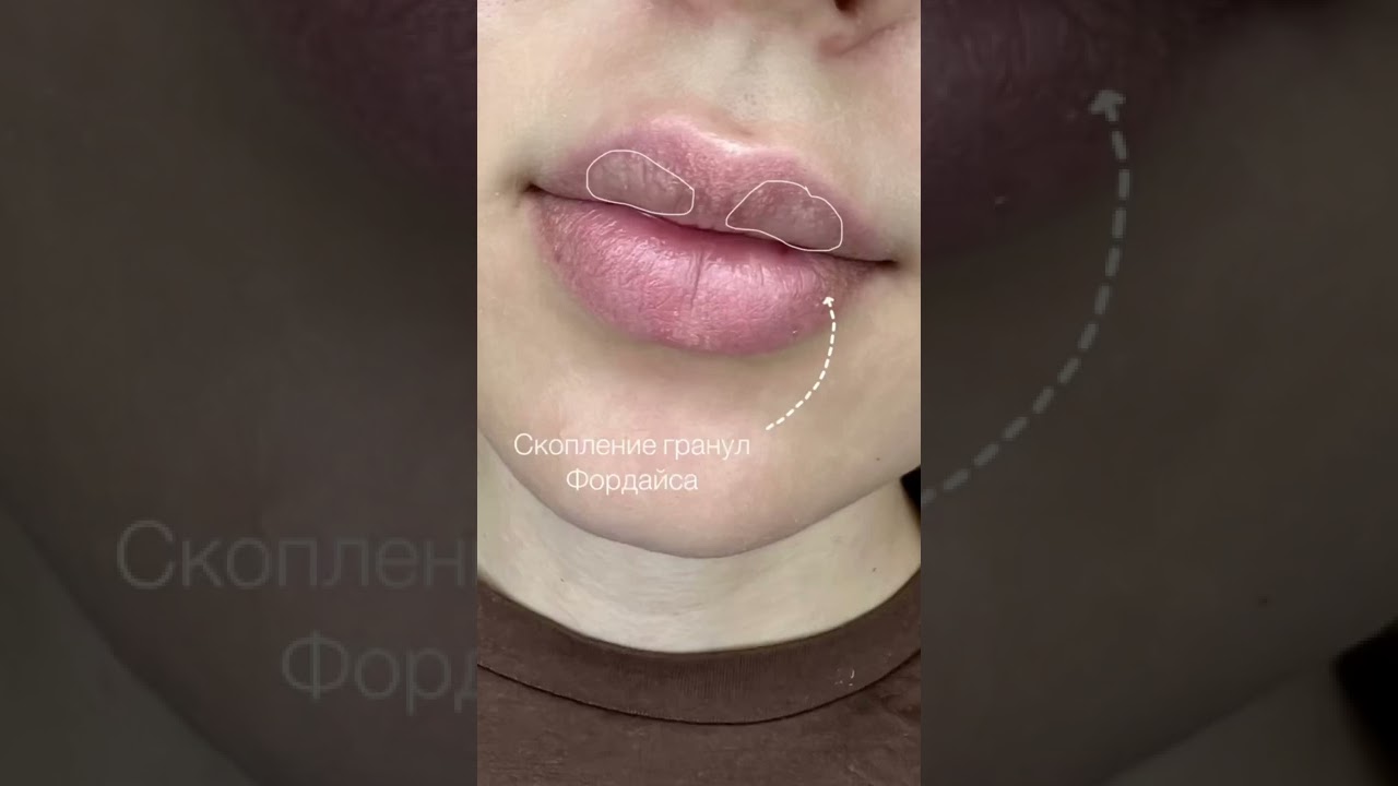 Работа с гранулами Фордайса. #перманентгуб #губы #shorts #губытатуаж