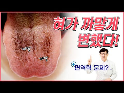 혀가 검은색으로 변했어요! 흑태, 흑모설 치료하려면?