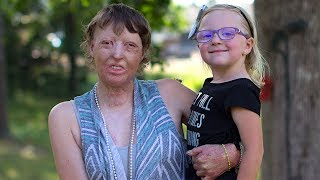 Burns Survivor Mum Rebuilds Her Life
