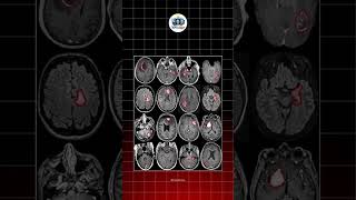 Can You Spot the Brain Tumor? 🧠 #medicosstuff #radiology #mri #brain #tumour