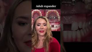 Download Lagu MARPE 🚨🚨🚨🚨🚨 we boren de expander tot aan het gehemelte!!!! Het zorgt voor meer stabiliteit bij he... MP3