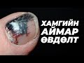 ТА ИЙМ АЙМШИГТАЙ ӨВДӨЛТИЙГ ТЭСЭЖ ЧАДАХ УУ???