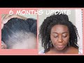 6 Months Hair Transplant Update/High Definition Results
