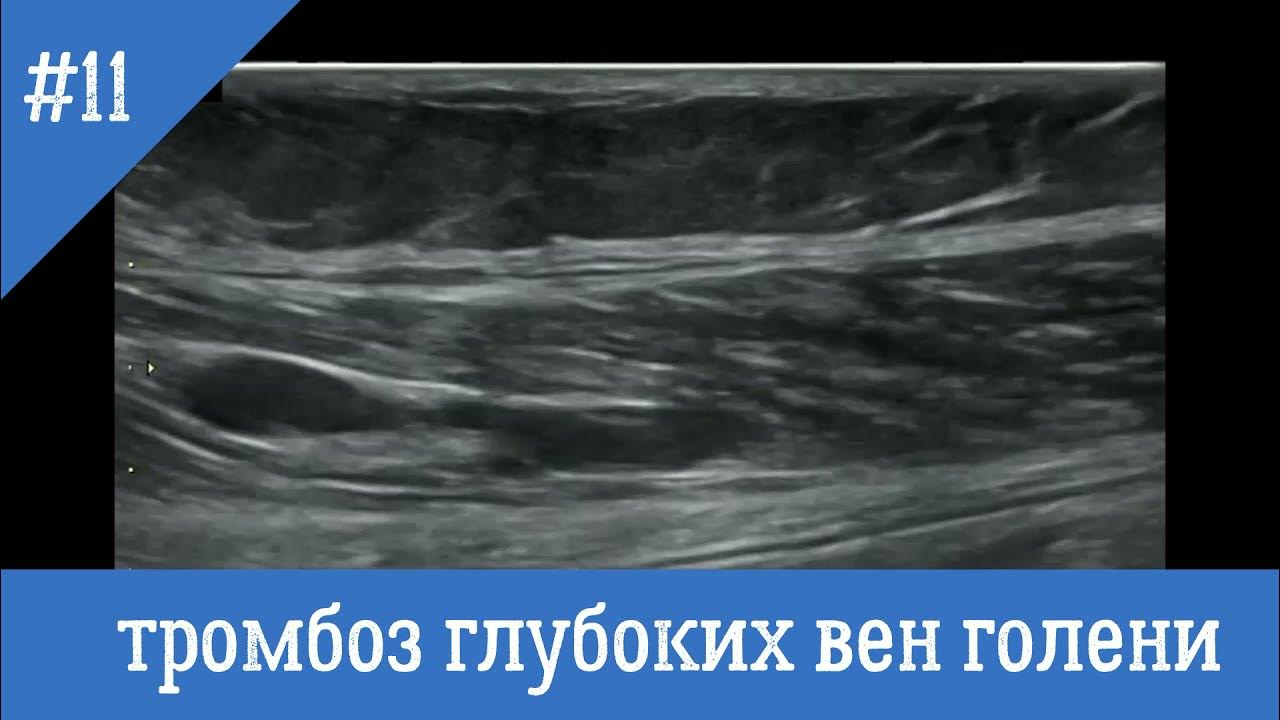 Узи вен тромбоз. Тромбоз глубоких вен УЗИ. Тромбоз вен голени на УЗИ.