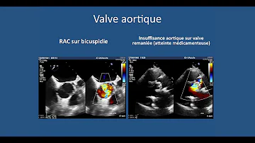 Comment se passe une échographie du cœur ?