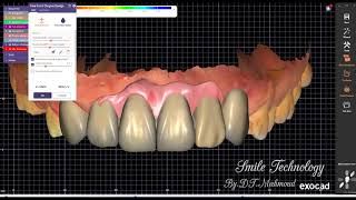 How To Design 6 Anterior Teeth With Gingiva Dental Design By Exocad