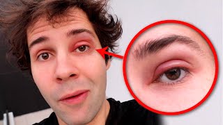 WHAT IS HAPPENING TO MY EYE!! by David Dobrik 8,243,202 views 2 years ago 5 minutes, 17 seconds