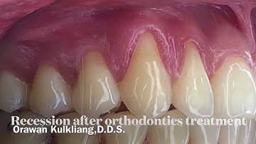 Recession Coverage with Ossix Volumax  . by Orawan Kulkliang,D.D.S.