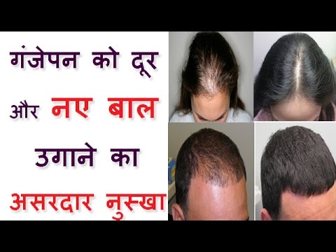 बल क परकतक तरक स दबर कस उगए  How to regrow hair  naturally in Hindi