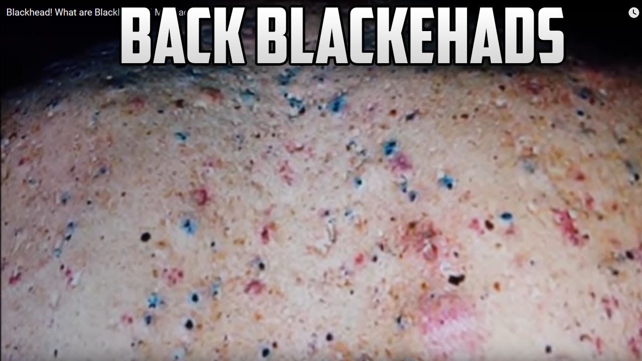 BACK Blackheads! What are Blackheads? Mr. Blackhead YouTube