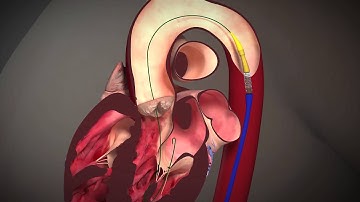 Heart - Edwards Sapien Transcatheter Heart Valve with RetroFlex 3 Transfemoral System
