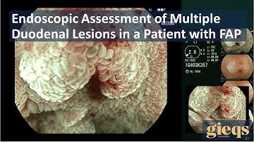 Endoscopic Assessment of Multiple Duodenal Lesions in a Patient with FAP