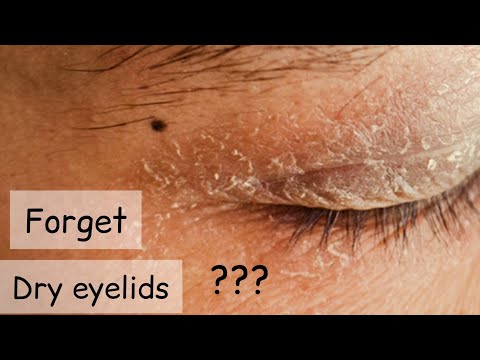 Dryness on Eyelids and Face Simple Home Remedy  ?? Dry Skin around Eyelids Treatment ??