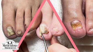 👣How to Fix Toenails that Change Shape and Color👣 screenshot 4