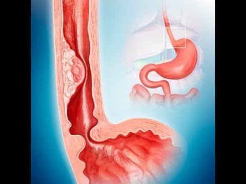 Diseases of the esophagus part 1 by ASM Minds