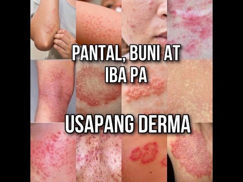 Video: Mga Impeksyon Sa Balat At Pagkawala Ng Mga Karamdaman Sa Kulay Ng Balat Sa Mga Pusa