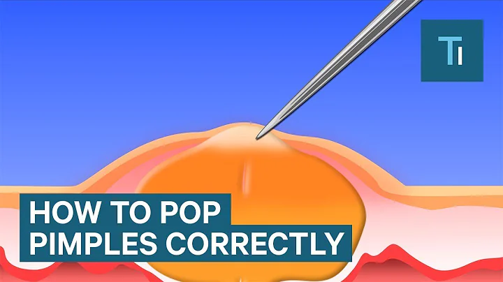 The Only Right Way To Pop Your Pimples - DayDayNews
