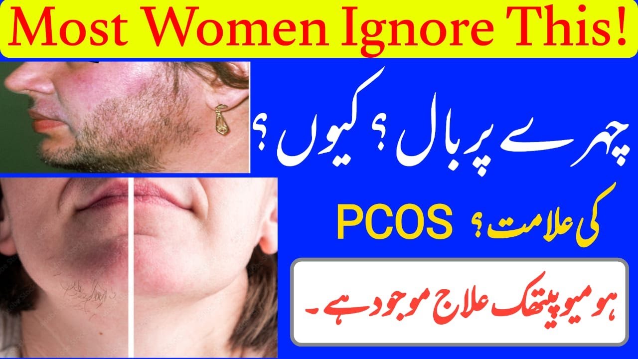 Best Homeopathic Medicines for Female Facial Hair | Hormonal Balance Treatment