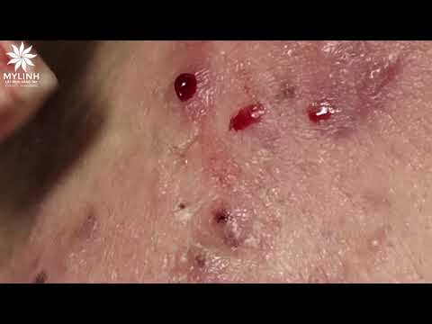 BLACKHEADS AND ACNE REMOVAL # | Nặn mụn ẩn dưới da, mụn đầu đen | 黑頭和粉刺去除 | 