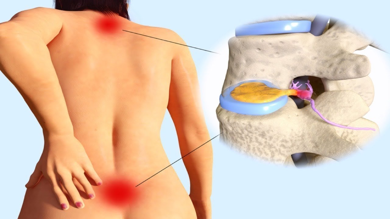 health insurance Home Remedies To Cure Pinched Nerve In Your Neck And Lower Back