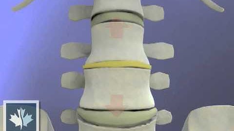 How Spinal Decompression Works | Back Clinics of Canada