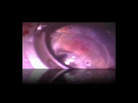 Intermediate Uveitis & Pars Planitis [Dr. E. M. Dodds]