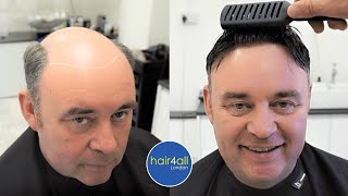Before & After | Hair System | Non-Surgical Hair Replacement System Men/Women | UK/USA/International